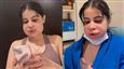 Uorfi Javed Turns Trolls Into Laughs As She Shows Off Swollen Face After Cosmetic Procedure!