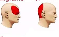 Types of Headaches