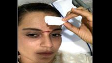 kangana-injured
