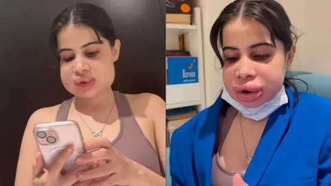 Uorfi Javed Turns Trolls Into Laughs As She Shows Off Swollen Face After Cosmetic Procedure!