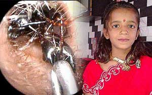 This Girl Has Ants Crawling Out of Her Ears Every Day