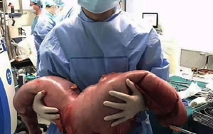 Constipated for 22 years, Chinese man has 13kg of poop removed from his body