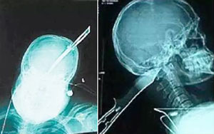 Man drives for 20 minutes to police station with a knife in his skull