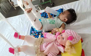 To Treat 11-Month-Old's Fracture, Doctors First Had To Plaster Her Doll