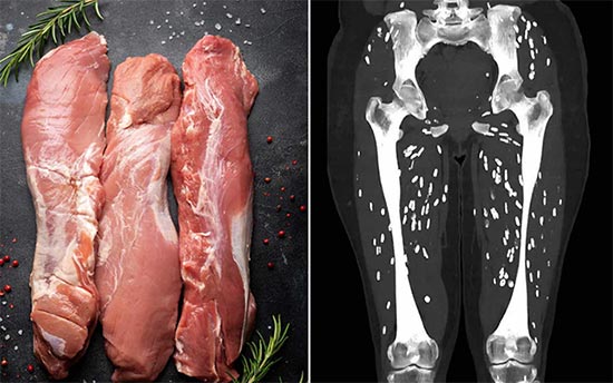 ‘Craziest’ CT scan shows patient's legs filled with tapeworm cysts after eating undercooked pork