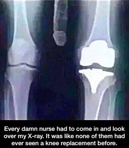 Knee Replacement X-Ray