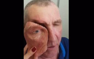 Life Changing Face Transplant of a Soldier